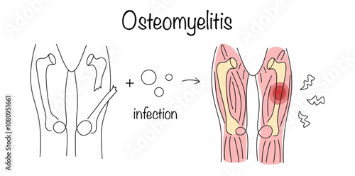 Osteomyelitis