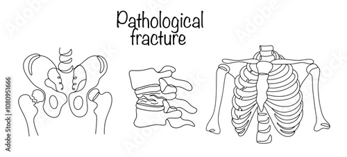 Pathological fracture