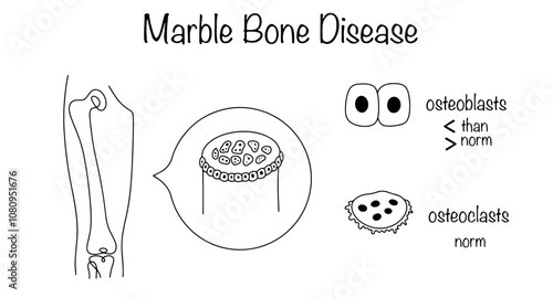 Marble Bone Disease