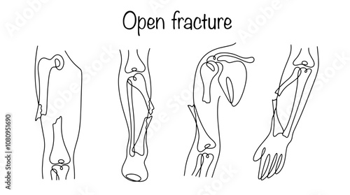 Open fracture