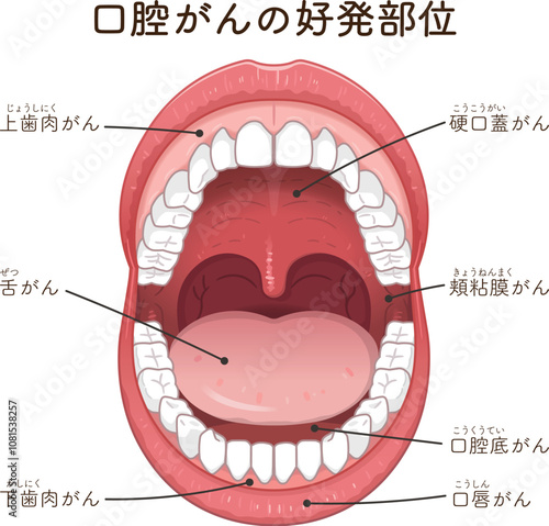 口腔がんの好発部位のイラスト　oral cancer illustration