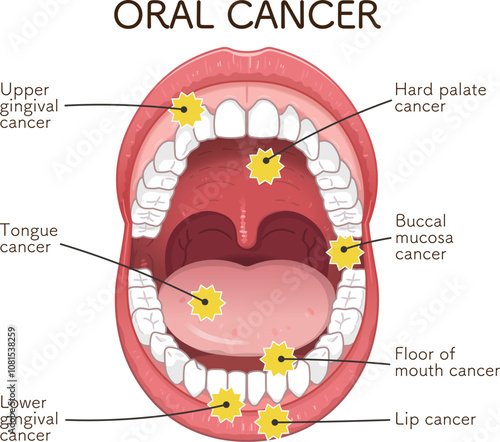 口腔がんの好発部位のイラスト　oral cancer illustration