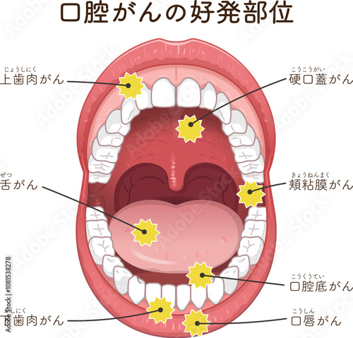 口腔がんの好発部位のイラスト　oral cancer illustration