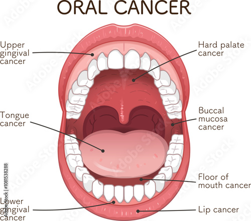 口腔がんの好発部位のイラスト　oral cancer illustration