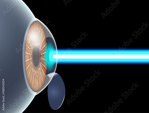 LASIK eye surgery