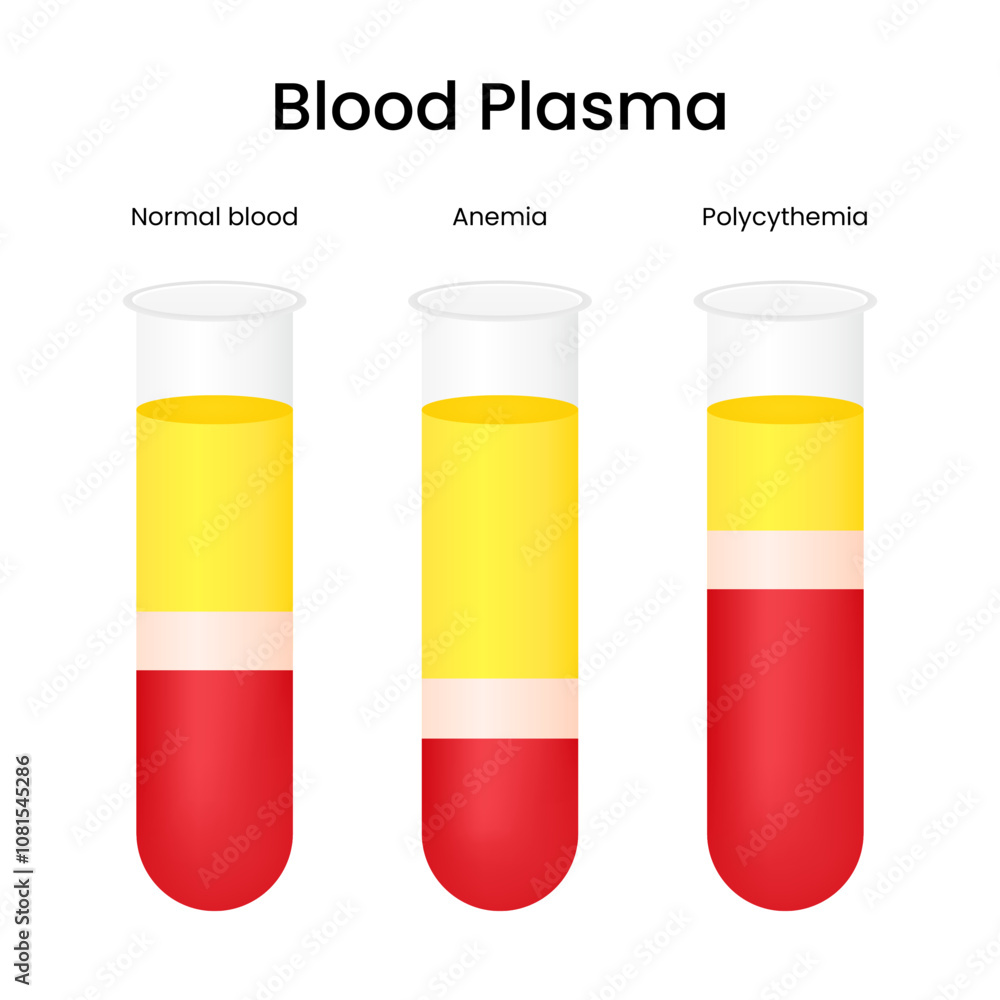 Blood Plasma of Normal Blood Anemia and Polycythemia Blood Plasma of Normal Blood Anemia and Polycythemia