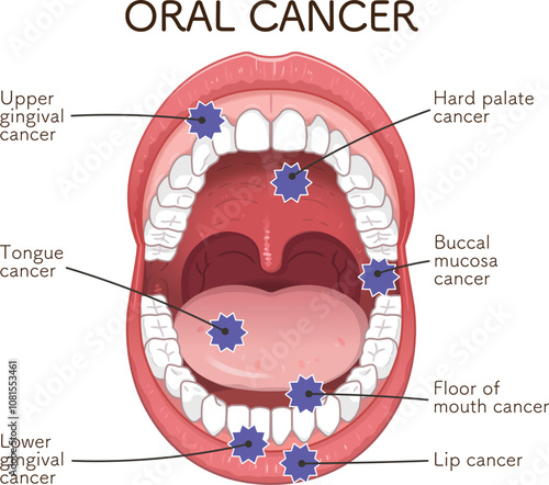 口腔がんの好発部位のイラスト　oral cancer illustration
