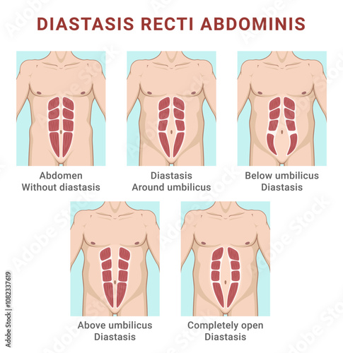Diastasis recti separation belly rectus types medical education scheme vector flat illustration