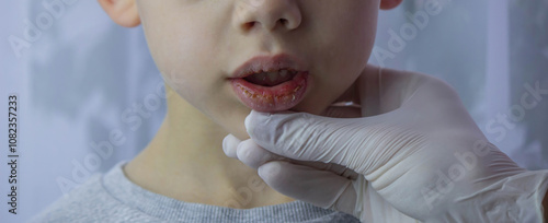 boy with chapped lips treatment. Selective focus