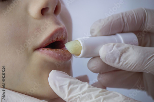 boy with chapped lips treatment. Selective focus