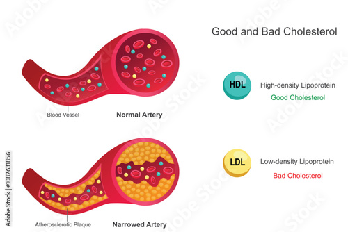 Good cholesterol (HDL) removes excess cholesterol from arteries, promoting heart health. Bad cholesterol (LDL) builds up in arteries, increasing heart disease risk.