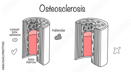 Osteosclerosis