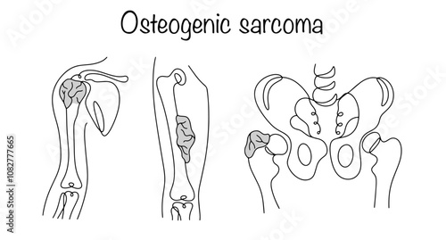 Osteogenic sarcoma