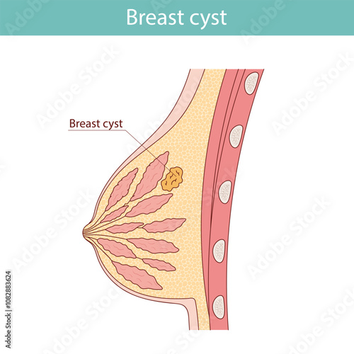 Female breast cyst. Anatomical medical illustration in cartoon style.