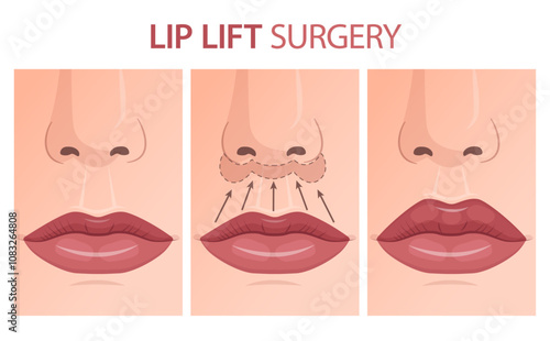 Vector illustration showing lip lift surgery. Can be used for educational or advertising purpose in cosmetology, aesthetic medicine.