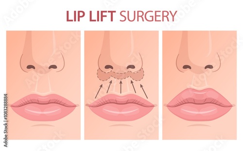 Vector illustration showing lip lift surgery. Can be used for educational or advertising purpose in cosmetology, aesthetic medicine.