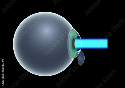 LASIK eye surgery