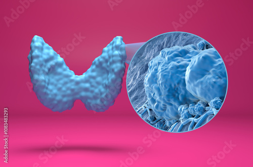 Thyroid cancer cells - isometric view 3d illustration photo