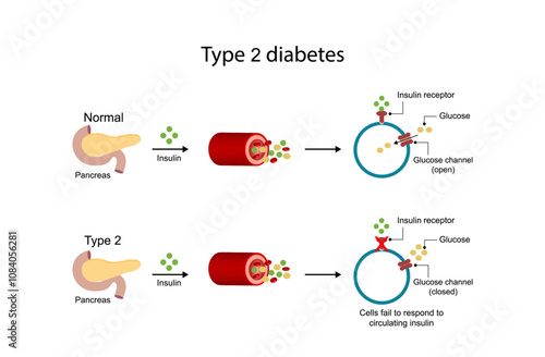 Diabetes mellitus type 2, cells fail to respond to insulin (Insulin resistance). high blood glucose levels. Vector Diagram illustration