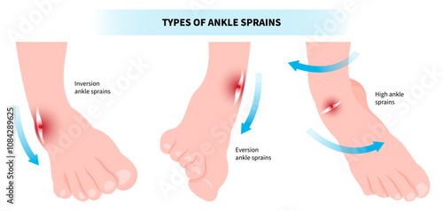 Types of ankle sprain and the ligament tear injury