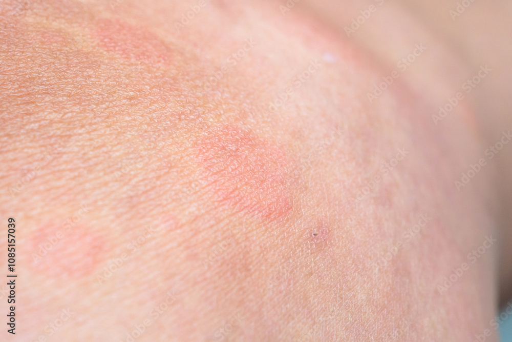 Young asian man has allergic skin rash on his legs from itchy dry skin eczema dermatitis insect bites Young asian man has allergic skin rash on his legs from itchy dry skin eczema dermatitis insect bites