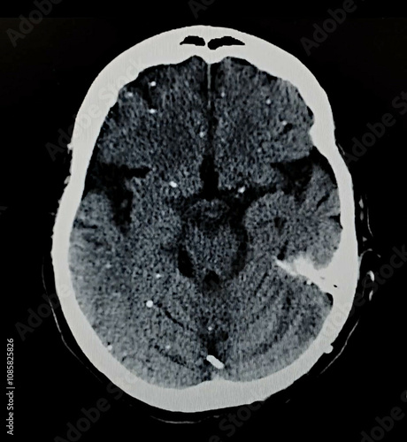 Brain CT with Cysticercosis - Calcified Larvae of Pork Tapeworm