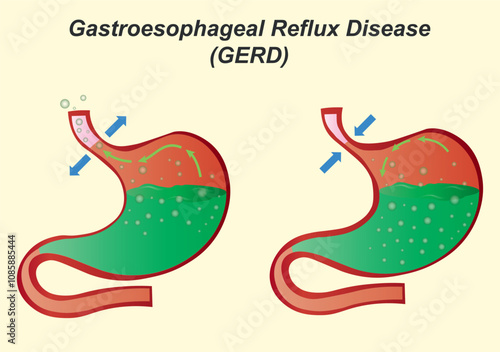 Gastroesophageal Reflux Disease GERD. Stomach anatomy structure. Digestive system organ cross section diagram. Stomach disease.
