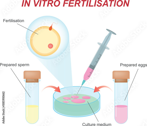 In vitro fertilization method - Co-incubation. Sperm and the egg are incubated in the laboratory
