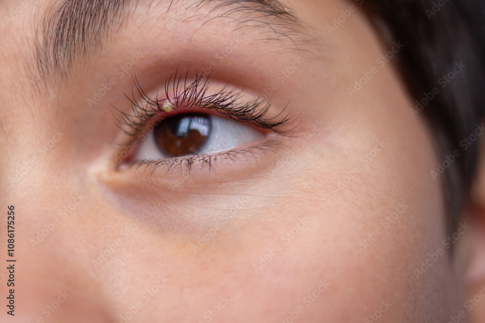 Close-up of human eye with small stye on upper eyelid. Macro shot of irritated eye and lashes. Health and medical concept Close-up of human eye with small stye on upper eyelid. Macro shot of irritated eye and lashes. Health and medical concept
