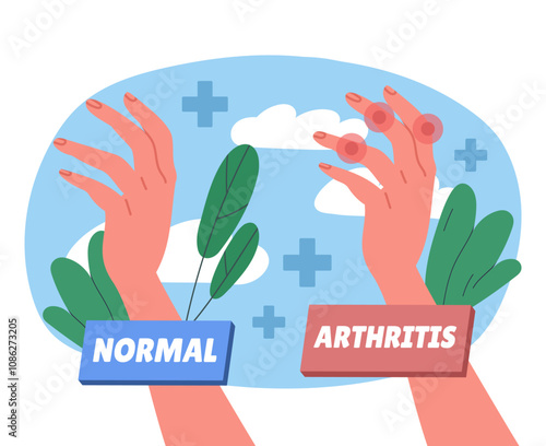 Hand with arthritis. Normal and arthritis female hands. Healthcare and medicine. Diagnosis and treatment. Person with joint pain. Flat vector illustration isolated on white background