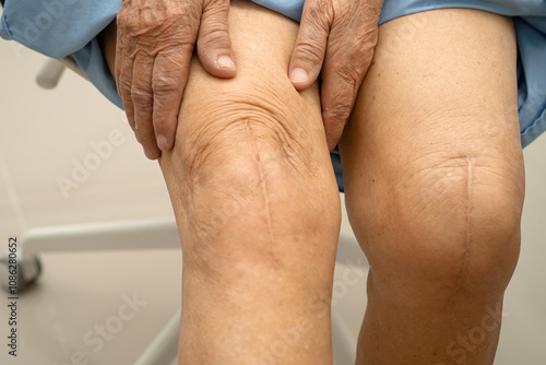 Fotografia Asian elderly woman patient with scar knee replacement surgery in hospital