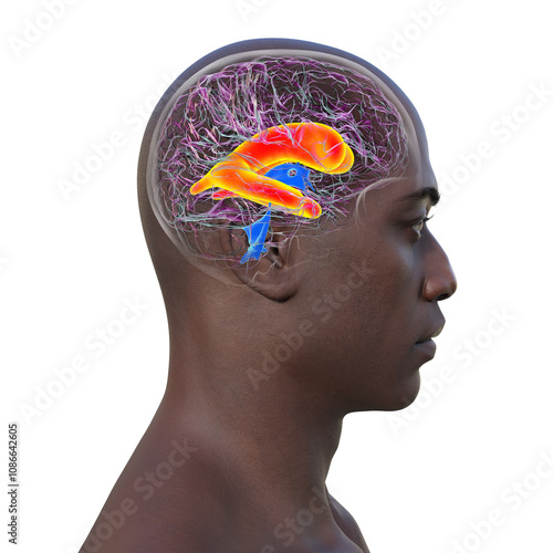 Enlarged lateral ventricles of the brain, 3D illustration photo