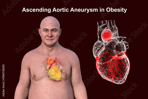 3D Illustration of a man with obese heart and aortic aneurysm photo