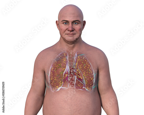 Lung miliary tuberculosis, 3D illustration photo