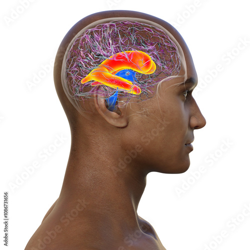 Enlarged lateral ventricles of the brain, 3D illustration photo