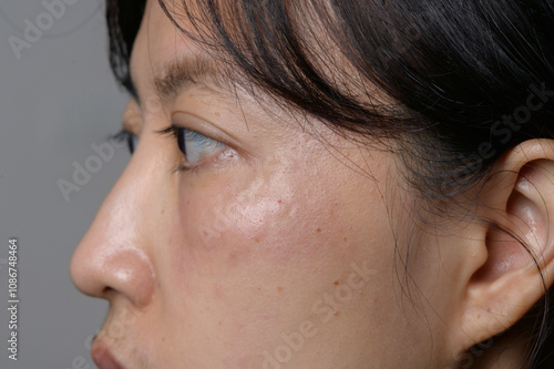 Side profile of woman with facial skin swelling and redness photo