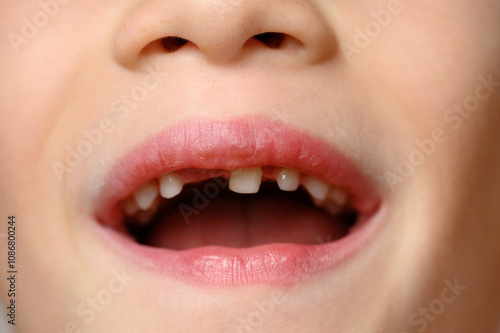 Child opens his mouth to show loose baby tooth and an erupting front permanent tooth next to it, close-up. Baby teeth are replaced by permanent teeth. Pediatric dentistry, changing teeth photo