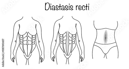 Diastasis recti