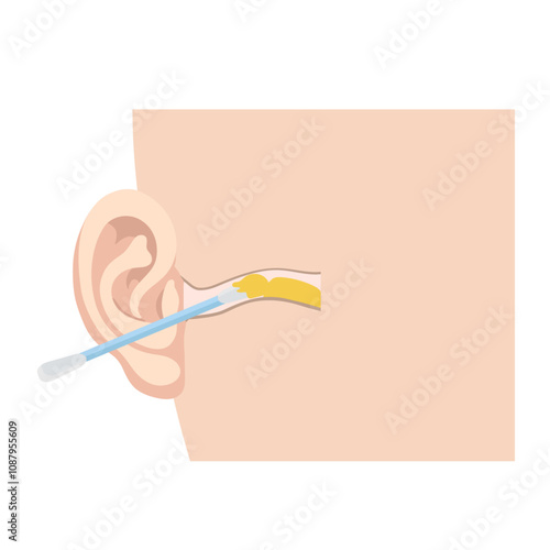 Ear wax  with using ear stick anatomy
