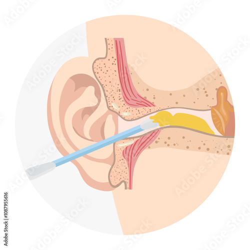 Ear wax  with using ear stick anatomy