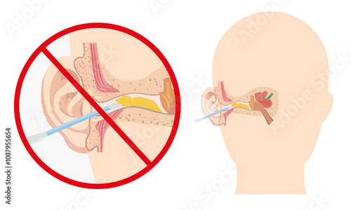 Ear wax with using ear stick anatomy. Warning using q tip