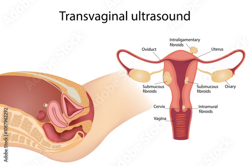Ultrasound vaginal examination Diagnosis of fertility problems menstrual cells cervical polyp
