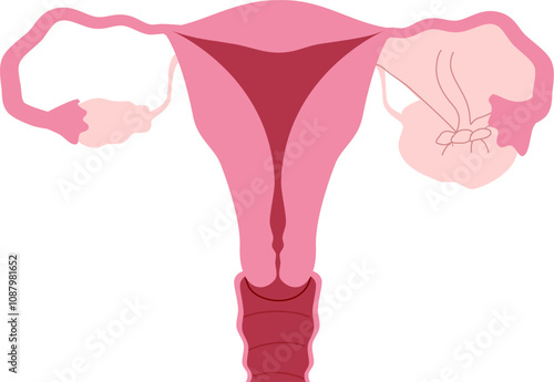 Ovarian disease illustration. Ovarian torsion 