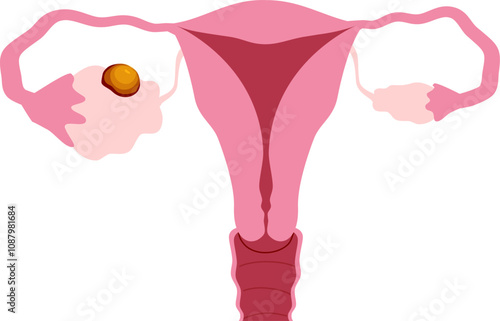 Ovarian disease illustration. Ovarian cancer