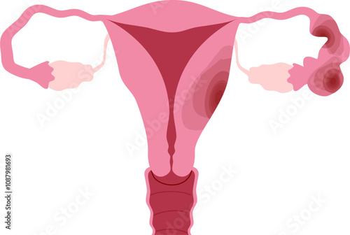 Ovarian disease illustration. Pelvic inflammatory disease 