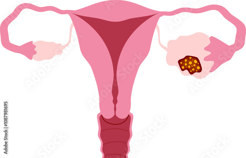 Ovarian disease illustration. Ovarian cancer photo