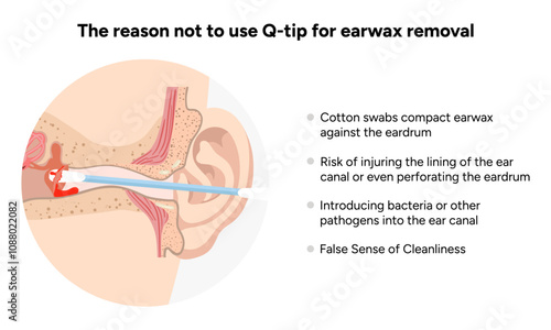 The reason not to use q-tip for earwax removal. Medical information