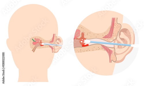 The reason not to use q-tip for earwax removal