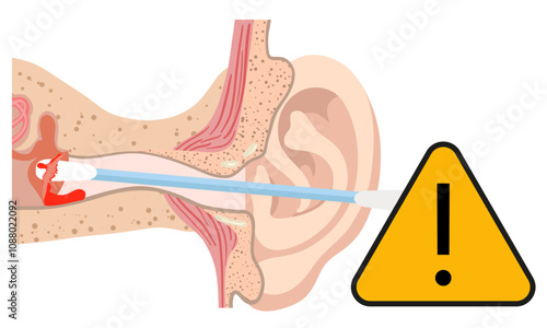 The reason not to use q-tip for earwax removal