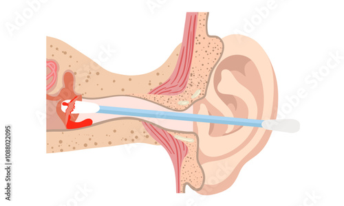The reason not to use q-tip for earwax removal